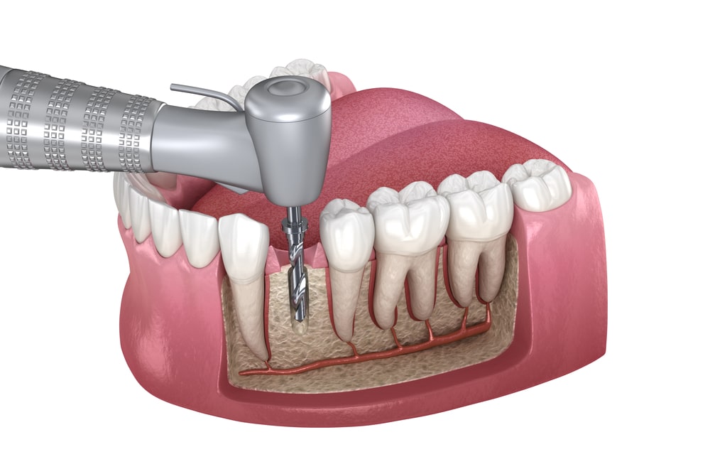 Root Canal Treatment Explained: Saving Your Tooth with Precision Care - Press Release Submission Sites Free, Free Instant Approval Guest Posting Sites