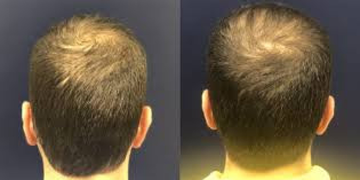 Why Los Angeles Men Are Choosing Non Surgical Hair Replacement Over Transplants