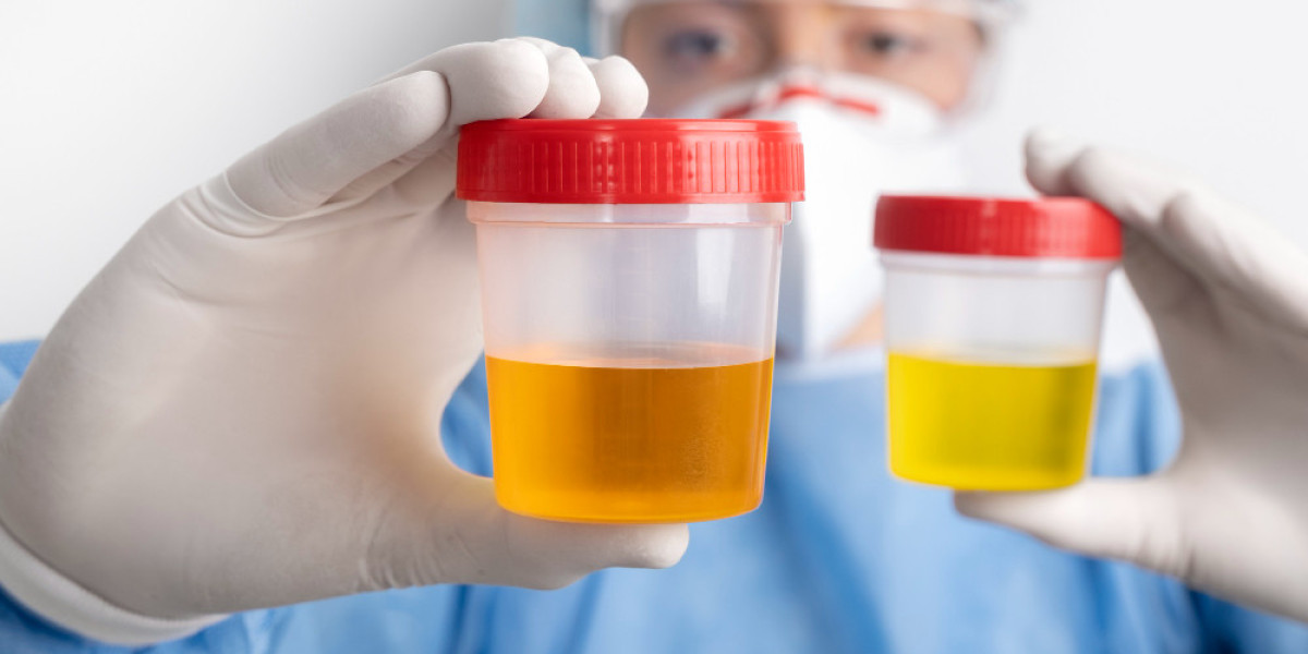 Dark Urine: Symptoms | Signs | Diagnosis | Treatment